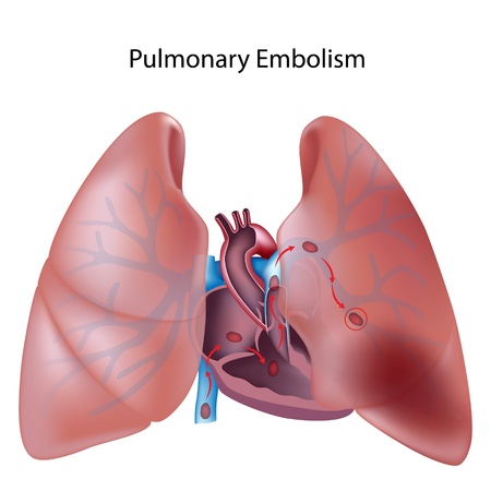 Pulmonary embolismのイラスト素材