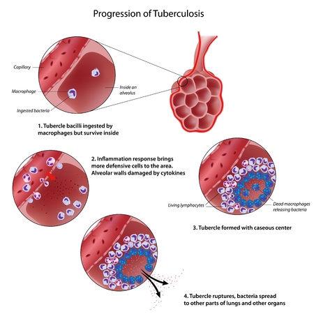 Progression of pulmonary tuberculosisのイラスト素材