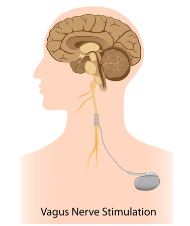 Vagus nerve stimulation therapyのイラスト素材