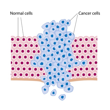 Cancer cells in a growing tumorのイラスト素材