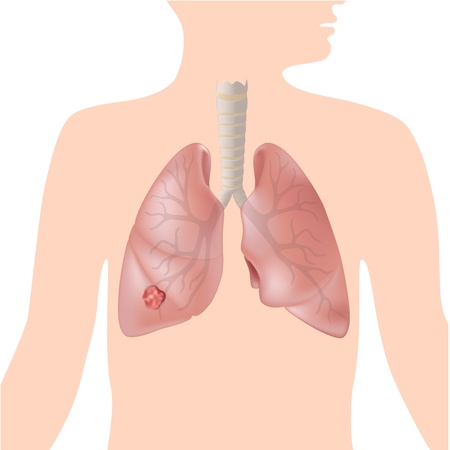 Lung cancerのイラスト素材