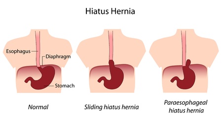 hiatus herniaのイラスト素材