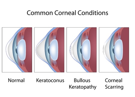 Common corneal conditionsのイラスト素材