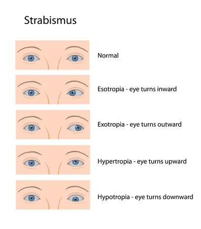 Strabismusのイラスト素材