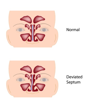 Deviated nasal septumのイラスト素材