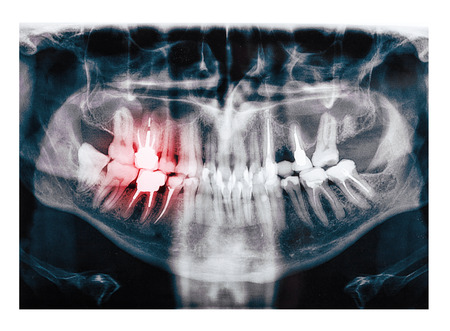 X-ray scan of humans teeth, simulated painの写真素材