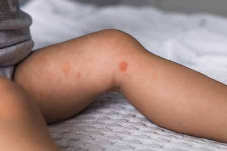 baby feet with dry red inflamed spots of atopic dermatitis, food allergy or eczema disease. babys face is not visible, skin disease conceptの写真素材