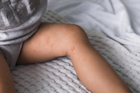 Allergic rash on the legs or feet of the toddler baby girl. Red rash, pimples from food allergies on...