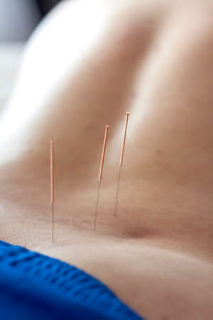 A man is being treated with acupuncture on his back. The acupuncture procedure. Back treatment.の写真素材