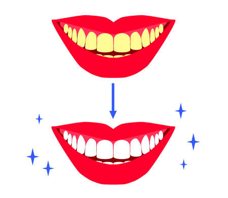 Smile with teeth on a white background. Whitening. Vector illustration.のイラスト素材