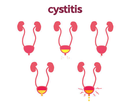 Bladder on a white background. Cystitis. Vector illustration.のイラスト素材