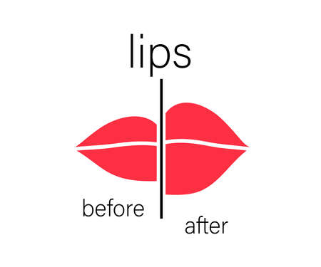 Lips before and after injection. Symbol. Vector illustration.のイラスト素材