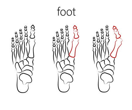 Human foot. Improper bone fusion. Symbol. Vector illustration.のイラスト素材