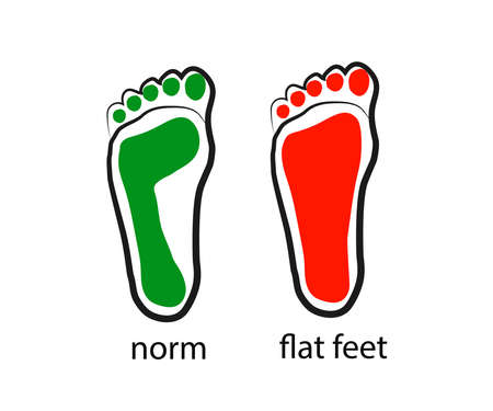 Human footprint. Flat feet. Symbol. Vector illustration.のイラスト素材
