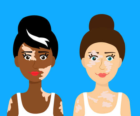 Women with vitiligo and different eye colors. Portrait. Vector illustration.のイラスト素材