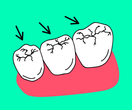 Caries on molars. Destruction of the enamel of human teeth. Dentistry. Cartoon. Vector illustration.のイラスト素材