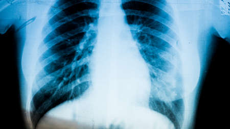 X-ray of pneumonia disease patient close up on reflective x-ray board in hospital.の写真素材
