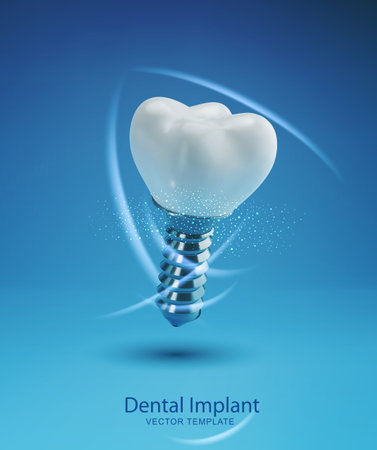 Vector template with realistic 3d prosthesis. Dental implant isolated on a blue background. Element...