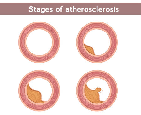 Stages of atherosclerosis. Development of atherosclerosis in the lumen of the vesselのイラスト素材