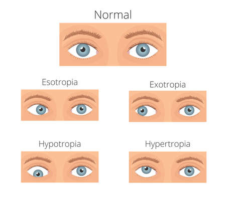 Strabismus vector illusration. Types of crossed eyesのイラスト素材