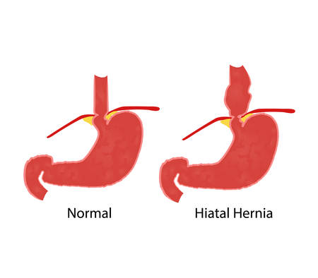 Hiatal hernia and normal anatomy of the stomach and esophagus vector illustrationのイラスト素材