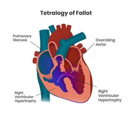 Ventricular septal defect with normal heart anatomy. Illustration of  the congenital defect of the ventricular wall