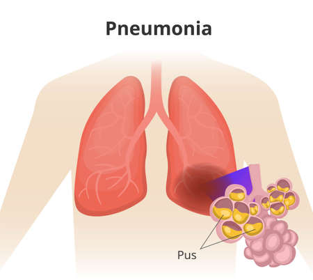 Illustration of the human lungs. Left lung is affected by pneumonia. Close up of alveoli with pusのイラスト素材