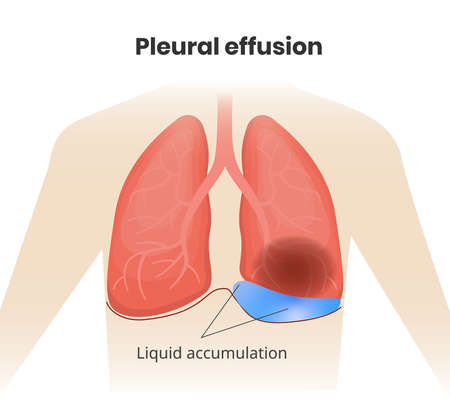 Illustration of the human lungs affected by pneumoniaのイラスト素材