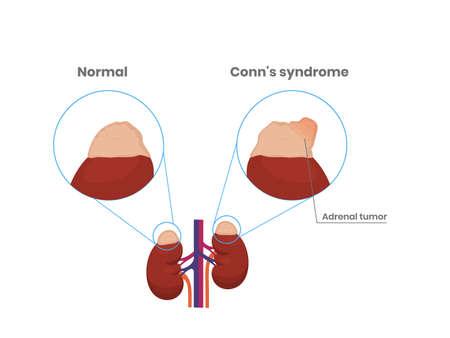 Adrenal gland normal anatomy and adrenal adenoma vector scientific illustrationのイラスト素材
