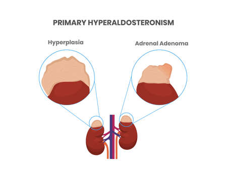 Primary aldosteronism.  Adrenal tumor and hyperplasia . Causes of high aldosteroneのイラスト素材