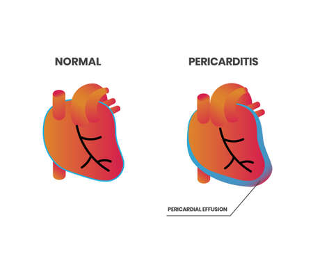 Normal heart anatomy vs pericarditis vector illustration. Pericardium inflmmation with pericardial effusionのイラスト素材