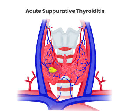 Acute suppurative thyroiditis vector illustration. Illustration of the bacterial thyroid abscess with increased bloodflowのイラスト素材
