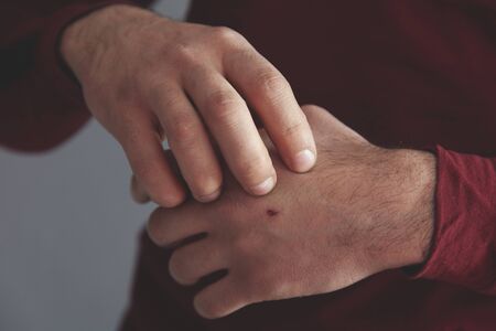 skin abrasion injury on the knuckles of the left handの写真素材