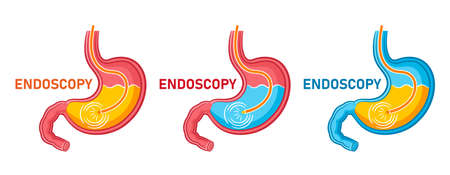Endoscopy stomach, gastroscopy icon set. Gastroenterology endoscope, medical examination digestive tract system, treatment gastritis, heartburn, ulcer internal organ. health care procedure flat vectorのイラスト素材