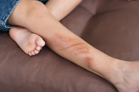 Wounds, scratches and abrasions on skin of child leg. Children injury.の写真素材