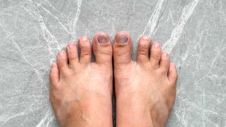 Feet on top with noticeable darkening and bruising on the big toes is a consequence of wearing tight shoes for a long time.の写真素材