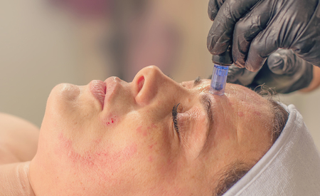 Needle mesotherapy treatment on a woman face. の写真素材