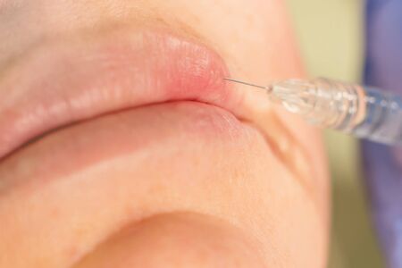 Beauty injections Close Up. Lip filler injection.の写真素材