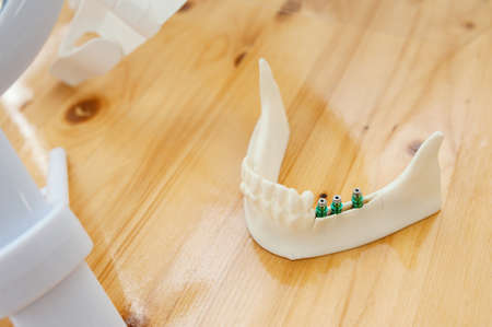 variant of the possibility of dental implantation on a human jaw modelの写真素材