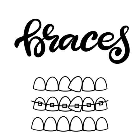 Lettering illustration about dental healthcare with the image of braces on teeth. EPS10. &#xD;Vector image of the stages of orthodontic treatment for posters for dental clinic.のイラスト素材
