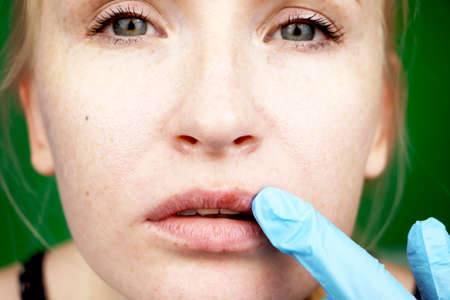 herpes on the lips, part of a woman's face with finger on lips with herpes, beauty conceptの写真素材