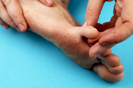 Fungus of foot close-up, isolated on blue background. The concept dermatology, treatment fungal and fungal infections in humans. Macro photograph human parasites. Rear background of a dermatologistの写真素材