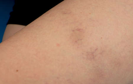Varicose veins and capillary veins in the legs. Medical inspection and treatment