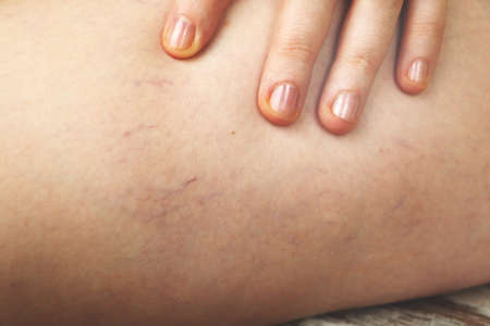 Varicose veins and capillary veins in the legs. Medical inspection and treatment