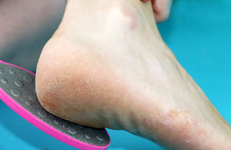 Cleaning foot feet with a saw or brush. Cleaning the feet of the fungusの写真素材