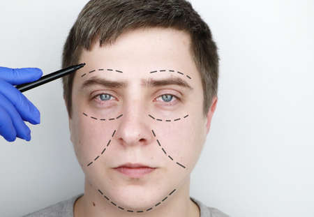 A man at the reception at the plastic surgeon. Before plastic surgery: eyebrow, forehead, chin and cheek liftの写真素材