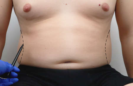 Tummy tuck, liposuction, breast surgery. A plastic surgeon prepares a man for plastic surgery.の写真素材