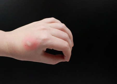 Redness and itching on the arm. The doctor examines the hand on which the bite of an insect, a mosquitoの写真素材