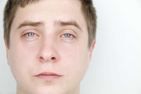 Ophthalmology, allergies, tearing. Portrait of a man who is cryingの写真素材