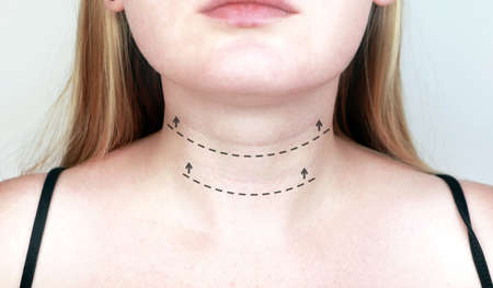 A cosmetologist prepares the patient for surgery: contour plastics of the neck, mesotherapy or...